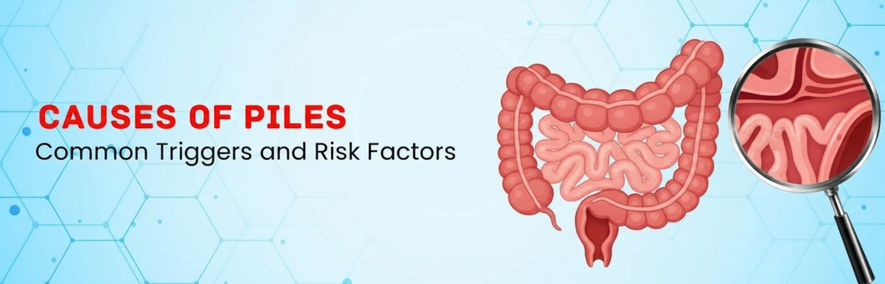  बवासीर के कारण - Causes of Piles in Hindi